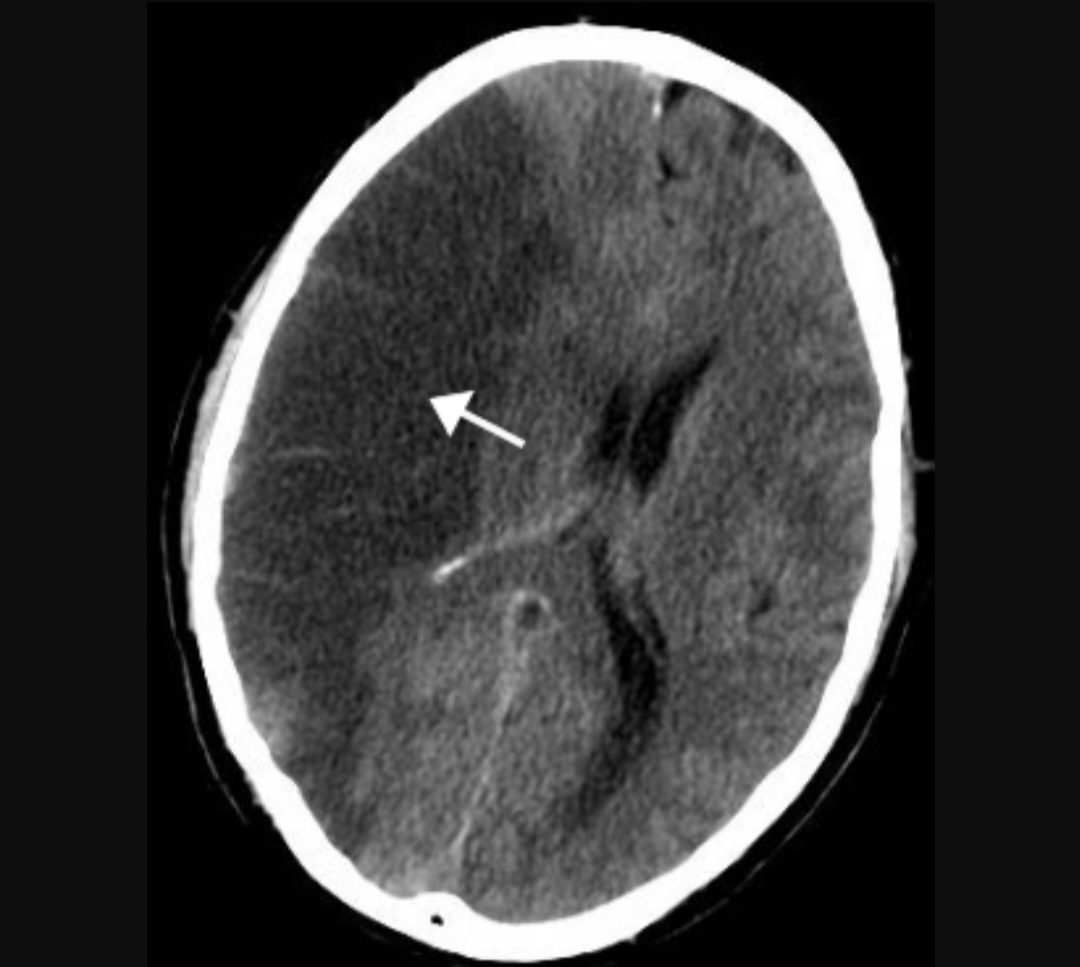 Brain stroke Tests 