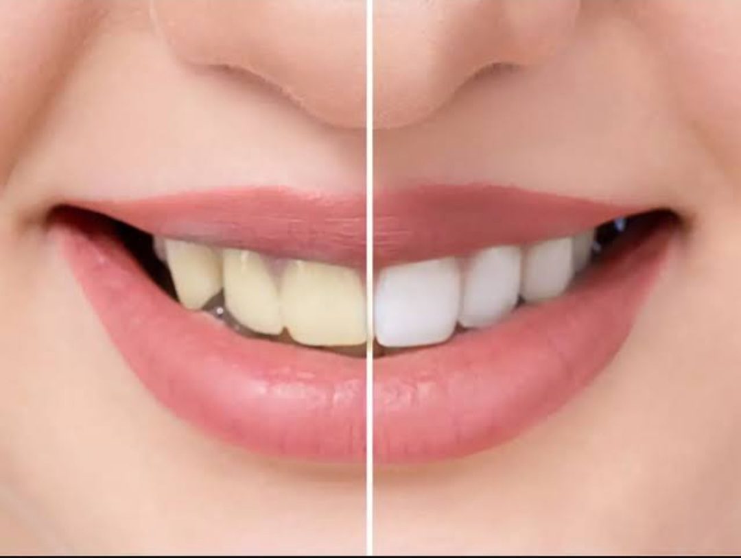 10 Proven Ways To Get White Teeth At Home by Natural methods