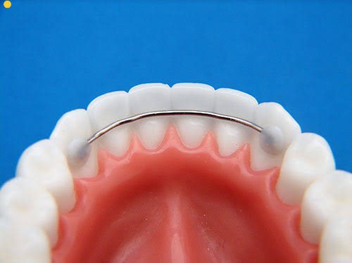 All about Permanent retainers