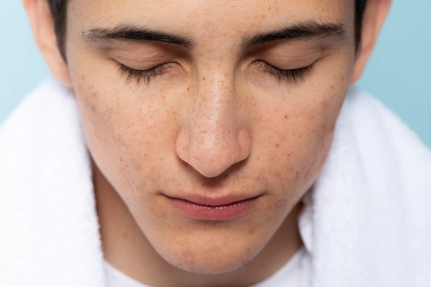 Remedies For Minimizing Enlarged Pores