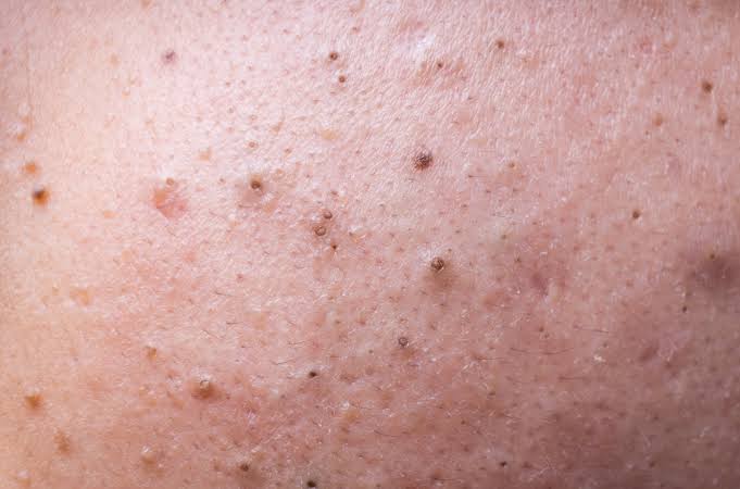 What are blackheads